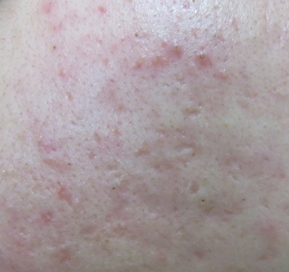 傷跡修正＋ニキビレーザー治療前