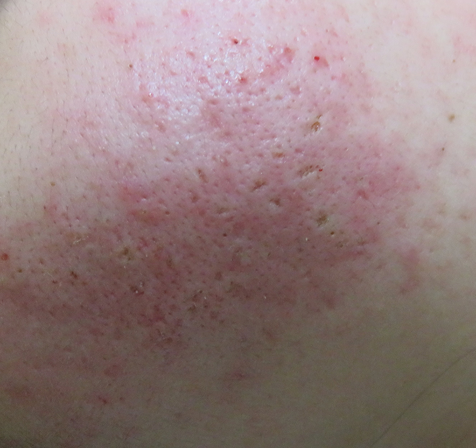 傷跡修正＋ニキビレーザー治療直後