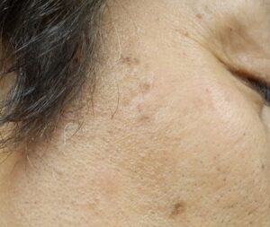 シミのレーザーの治療結果（ビフォー）