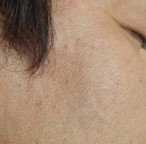 シミのレーザーの治療結果（アフター）