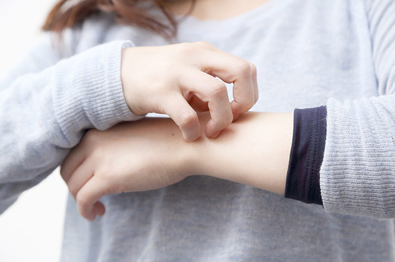 湿疹、アトピー性皮膚炎